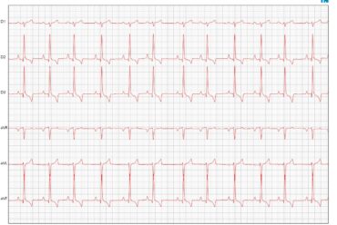 5 Erros Mais Comuns no ECG