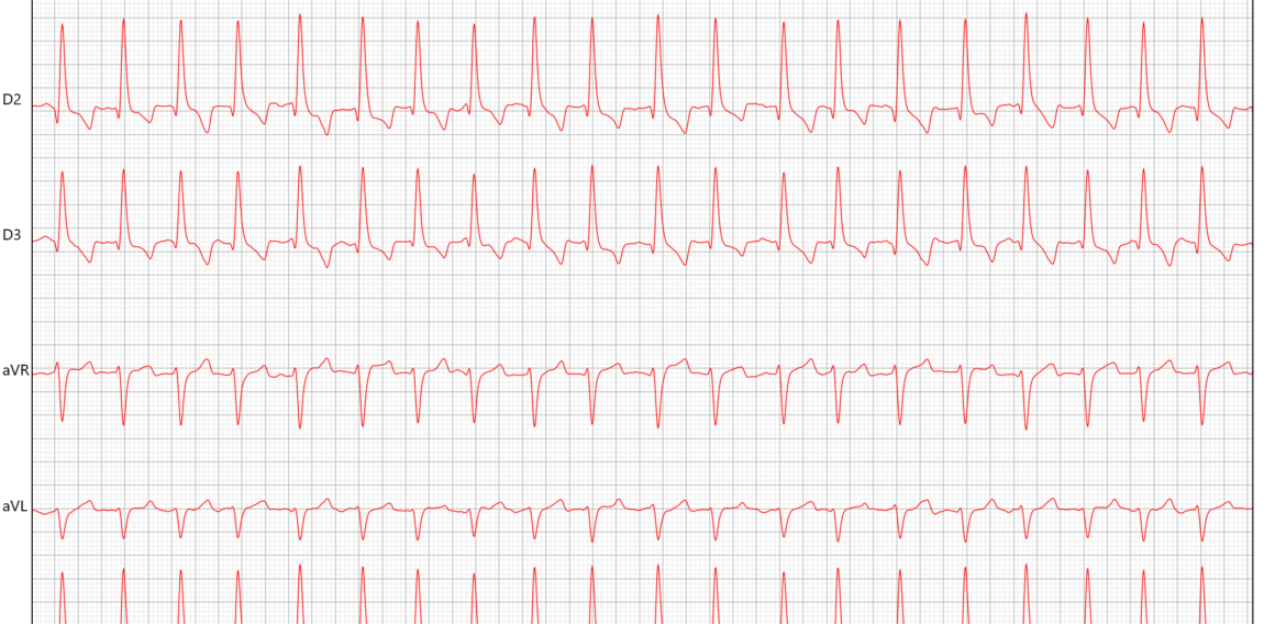 Fibrilação Atrial