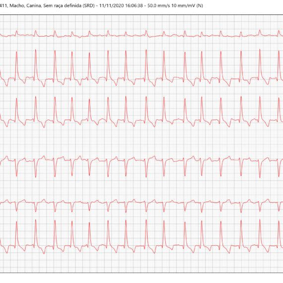 Fibrilação Atrial