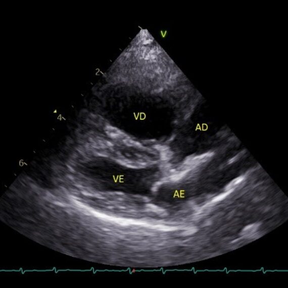 Ajustes na Imagem Ecocardiográfica – Ganho