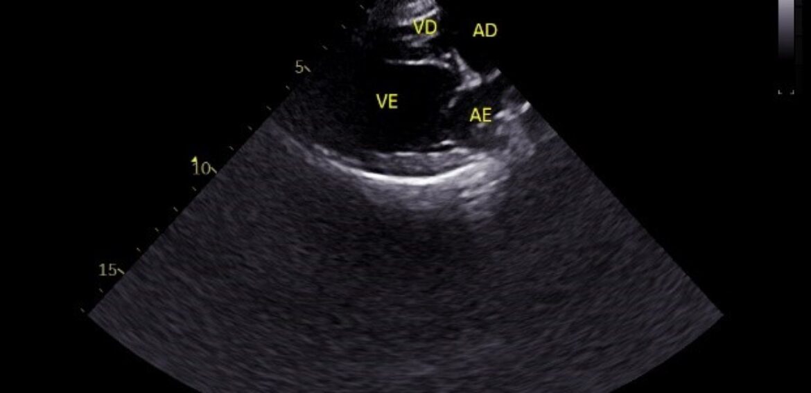 Ajustes na Imagem Ecocardiográfica – Profundidade (Depth)