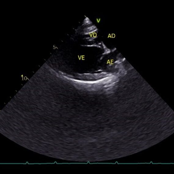 Ajustes na Imagem Ecocardiográfica – Profundidade (Depth)