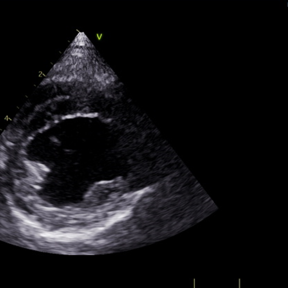 Ajustes na Imagem Ecocardiográfica – Largura do Setor (FOV)